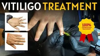Vitiligo treatment | 100% Results | Zero side effects | Machu tattoos | Marathahalli Bangalore