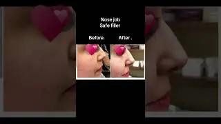 #boardcertifieddermatologist #nosejobbeforeandafter #fyp شعب_الصيني_ماله_حل #nosefiller #ghadakassab