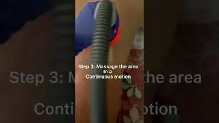 Vacuum RF for Back Fat Reduction | SculptSkin #shorts #vacuumtherapy