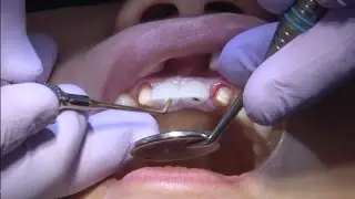 Chairside Live Episode 177: Screw-Retained Anterior Crowns using Obsidian&reg; Pressed to Metal