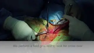 Natural Scar Penile Implant Titan Subcoronal with Peyronies disease 4K