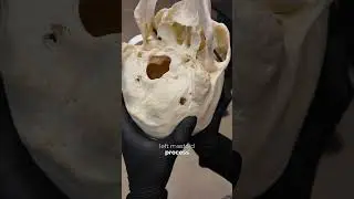 Exploring multiple myeloma  #bones #humanskull #cancer ￼