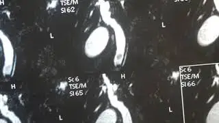 Large CBD Stone in elderly toxic patient (Chlangitis)