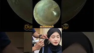 @bebirdofficial Earsight Ultra X VERSUS Klinik Al-Biruni's Endoscope