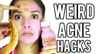 10 WEIRD Acne & Zit Hacks that work FAST!