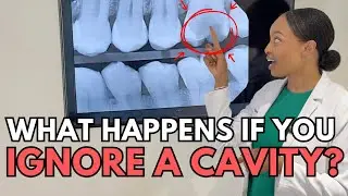 Cavities 101: What Happens If You Ignore a Cavity? | Dr. Alexis Washington, Washington Metro Dental