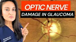 Glaucoma Optic Nerve Damage Explained By Glaucoma Specialist | Optic nerve cupping high eye pressure