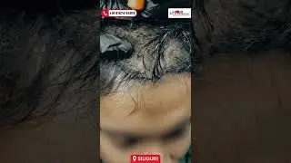 Scalp Micropigmentation (SMP) | Instant Hair Density Look | Real Client Result