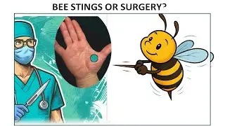 Bee Stings for Pain Relief. Treatment for back pain, arthritis,  #bees #pain #backpain #arthritis