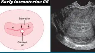 Sonographic Appearances of Normal vs Abnormal Intrauterine Pregnancy