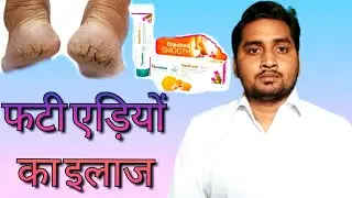 फटी एड़ियों का इलाज...[Rahul Pharma Clinic]