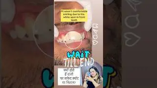 Treatment of white mark on tooth 🦷 #youtube #shortsviral #shorts #dentalprocedure