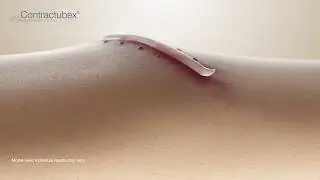 Contractubex&reg; GEL English