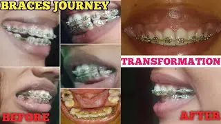 Teeth Braces Before And After Face Change ll Transformation  #braces #transformation #journey #vlog 