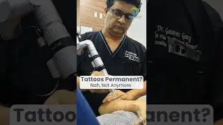 Live:  Laser Tattoo Removal in Minutes | #tattoos #tattooremoval #drgauravgarg