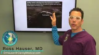 Ligament and tendon damage after antibiotic use - Prolotherapy and fluoroquinolone FAQ