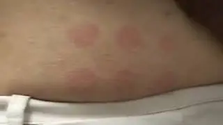 Photo-triggered solar urticaria in the laboratory