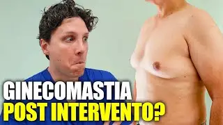 Ginecomastia: pu&ograve; ripresentarsi dopo l&rsquo;Intervento? Ecco la verit&agrave;!
