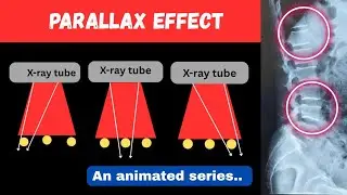 Parallax Effect ll  ll Radiographic image quality ll Radiology ll Radiography Simplified