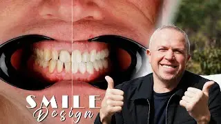 UK Patient Dental Treatment Journey at Dental Wise Turkey | Implants & Zirconium