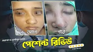নাকের রাইনোপ্লাস্টি সার্জারি - Rhinoplasty Before After Patient Review। Nose surgery in Bangladesh