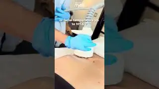 Venus Legacy Skin Tightening Explained