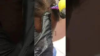 Scalp Micro-pigmentation