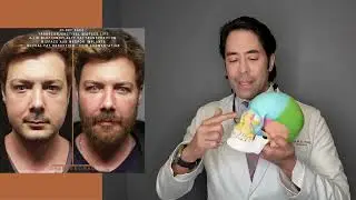 FACIAL MASCULINIZATION