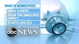 1st US case of monkeypox confirmed in Massachusetts