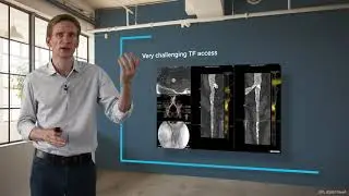IVL in practice, patient selection and cases: IVL Pre TAVI Tutorial Chapter 5 with Dr. Ole de Backer
