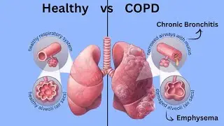 COPD Explained: Causes, Symptoms & Best Management Tips