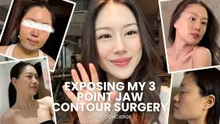 EXPOSING MY 3 POINT-JAW CONTOUR SURGERY done in South Korea!