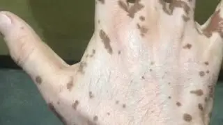 VITILIGO PIGMENTOZ PROCESS | VITILIGO PERMANENT TREATMENT | BEST VITILIGO TREATMENT