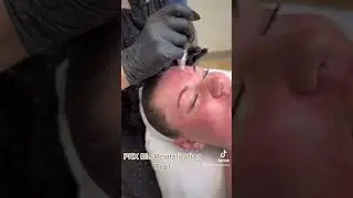 The No Peel, Pain Free, No Downtime Skin Treatment, PRX!