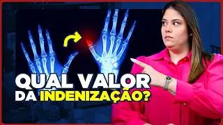 Valor da INDENIZAÇÃO por Perda de Dedo da Mão em 2025 (atualizado)