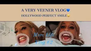 MIAMI VEENER VLOG: Hollywood Perfect Smile!!| Veneers, Hyaluron pen, and More! | More Life Vlog #2