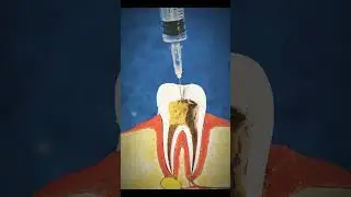 How to do root canal treatment. #shorts #viral #endodontics #bds #dentistry #animation