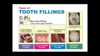 Tooth Decay