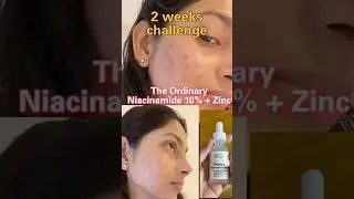 The ordinary niachinamide 10% + zinc 1% true review for dark sports and acne #shorts #viral #youtube