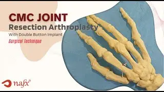 CMC DOUBLE BUTTON IMPLANT Surgical Technique