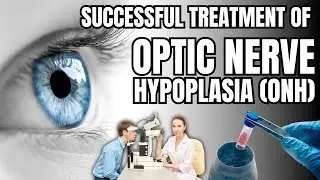 Stem cell Treatment Breakthrough for Optic nerve Hypoplasia (ONH)
