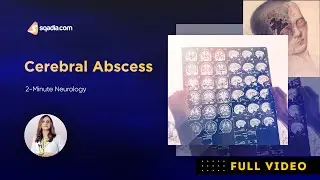 Cerebral Abscess Pathophysiology | 2-Minute Neurology Video | V-Learning&trade;