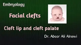 Embryology/ Cleft lip and cleft palate/Dr.Abeer Alnawi