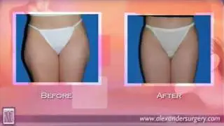 VASER&reg; Liposuction at Alexander Cosmetic Surgery in La Jolla, San Diego