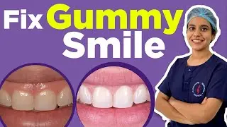😁 Gummy Smile Treatment In Delhi (India) ✳️How to Fix Gummy Smile - Causes, Diagnose, Procedure