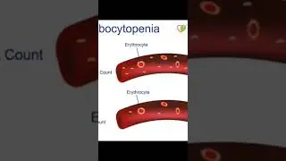 platelet deficiency #thrombocytopenia #bloodcells #doctor