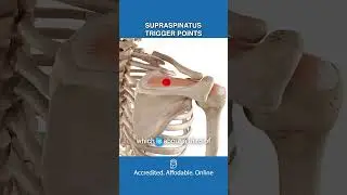 Вызывают ли триггерные точки надостной мышцы боль в руке?