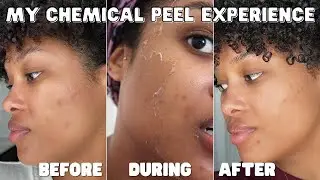 MY CHEMICAL PEEL EXPERIENCE! fading my acne spots?!