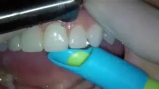 Laser removal of two eMax veneers with Fotona LightWalker Er:YAG