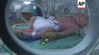 Rare conjoined twins born in Gaza
